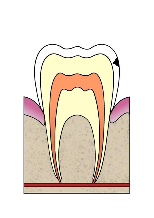 Image Ã©volution d'une carie