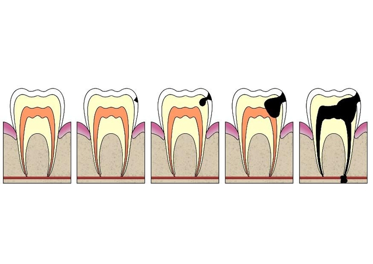 Image Ã©volution d'une carie